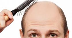 علاج و دواء الصلع الوراثى كيف يمكن التغلب على فراغات الشعر؟