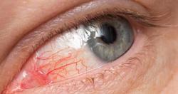 تعرف ما هو اسباب العين الورديه وطرق ووسائل علاج و دواءها