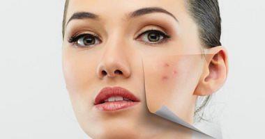 Learn about the simplest ways to get rid of face blisters and love