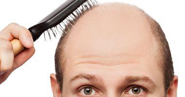 Treatment of genetic baldness How can hair spaces be overcome