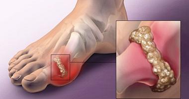 4 home treatments to solve the problem of uric acid highlighted by ginger