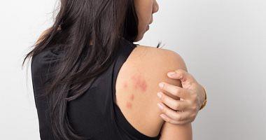 Know the KOH test to diagnose the skin fungus