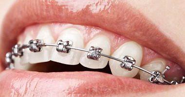 Tips after installation orthodontics are interested in the cleanliness of the mouth