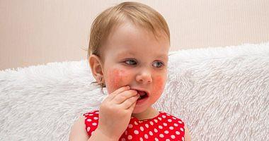 What is the inflammatory nose inflammation in children