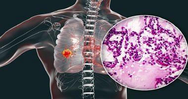 6 Warning marks should not be ignored indicate lung cancer