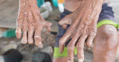 All you want to know about leprosy symptoms and treatment methods