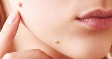 How to get rid of the mole with several medical methods laser highlighted