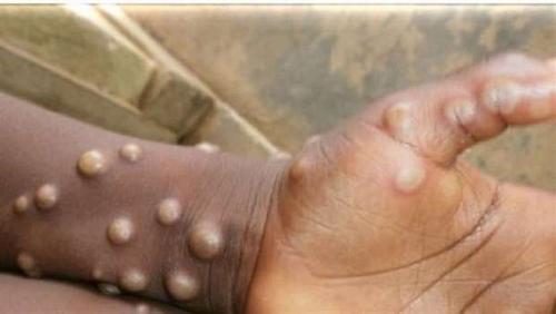 Monkey chickenpox disease is the cause of naming and the danger of infection