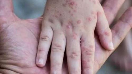 Monkery chickenpox in Peru most of the injured men