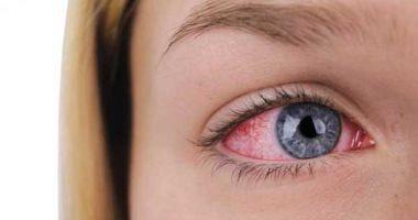 The causes of eye redness and tips for prevention