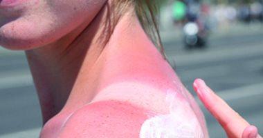 A natural component relieves the pain of sunburn and treating the skin