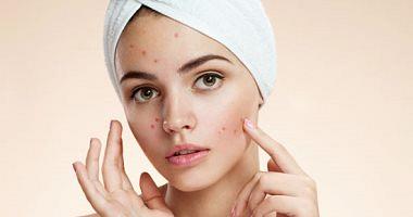 Treatment of acne scars in the face in many ways including laser