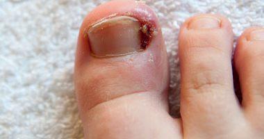 What are the causes of nail fighters and treatment methods