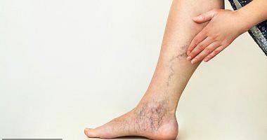 Learn about the causes of eczema for legs and symptoms of infection