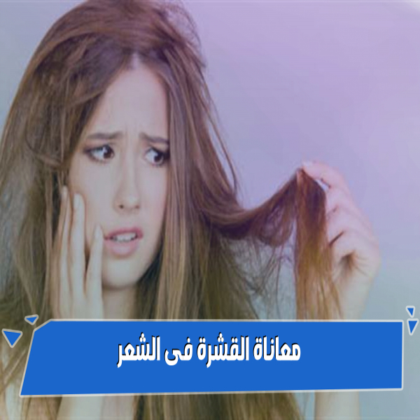 Winter increases the suffering of dandruff in hair causes and treatments