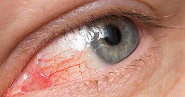 Learn about the causes of the pink eye and treatment methods