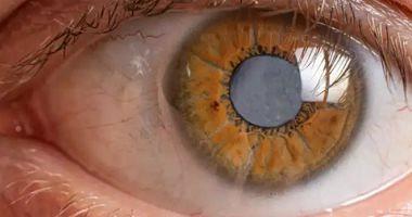 4 eye problems due to high blood sugar levels