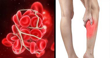 Signs of blood clot and prevention methods