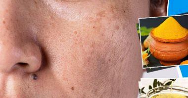 5 Household treatments for pigmentation of the skin including braces and saffron oil