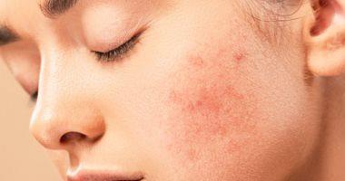 5 Wrong habits performing the spread of acne in summer