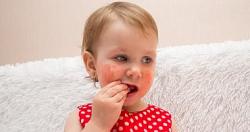 تعرف ما هو التهاب الانف التحسسي عند الاطفال؟