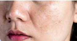 5 أنواع من الأمراض الجلدية التي يمكن أن تسبب الحمى كيف تحمي نفسك؟