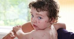اعراض جدرى الماء عند الاطفال واهم طرق ووسائل العلاج و دواء