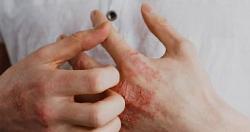 هل الطفح الجلدي علامة على الإصابة بعدوى COVID21؟ تعرف على علاماته